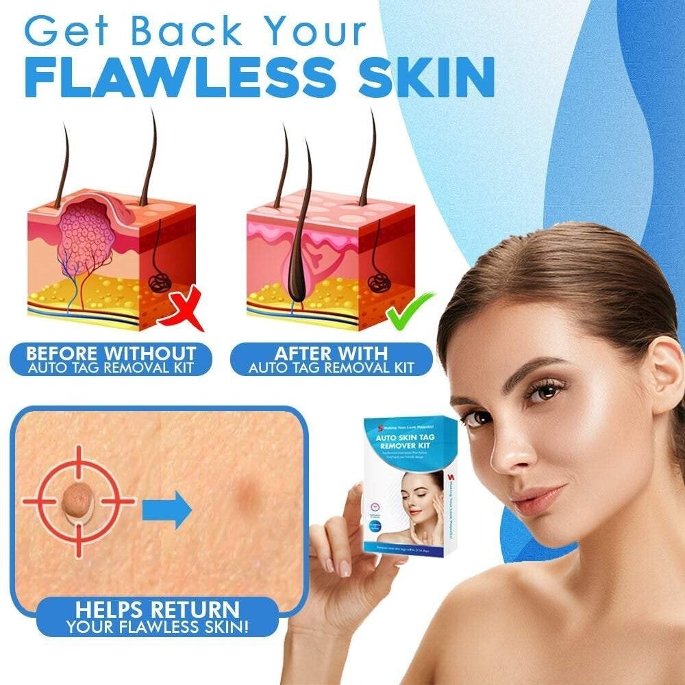 SMART Auto micro skin tag remover